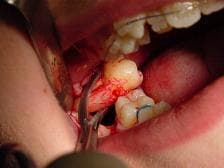 Dental Surgical Extraction