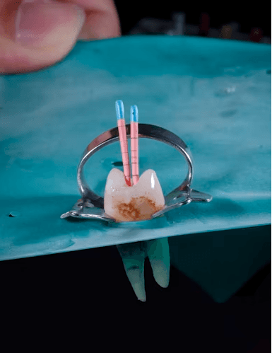 Root Canal Treatment (RCT)