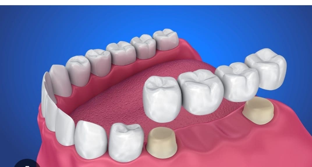 Crown and Bridge Dentistry
