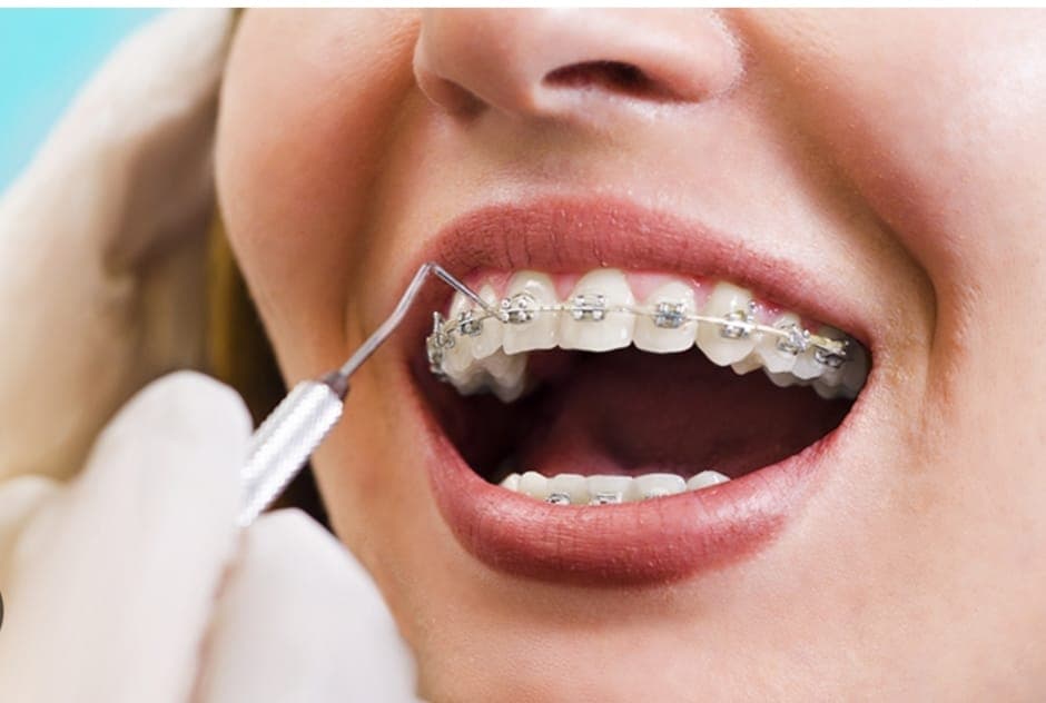Orthodontic Treatment