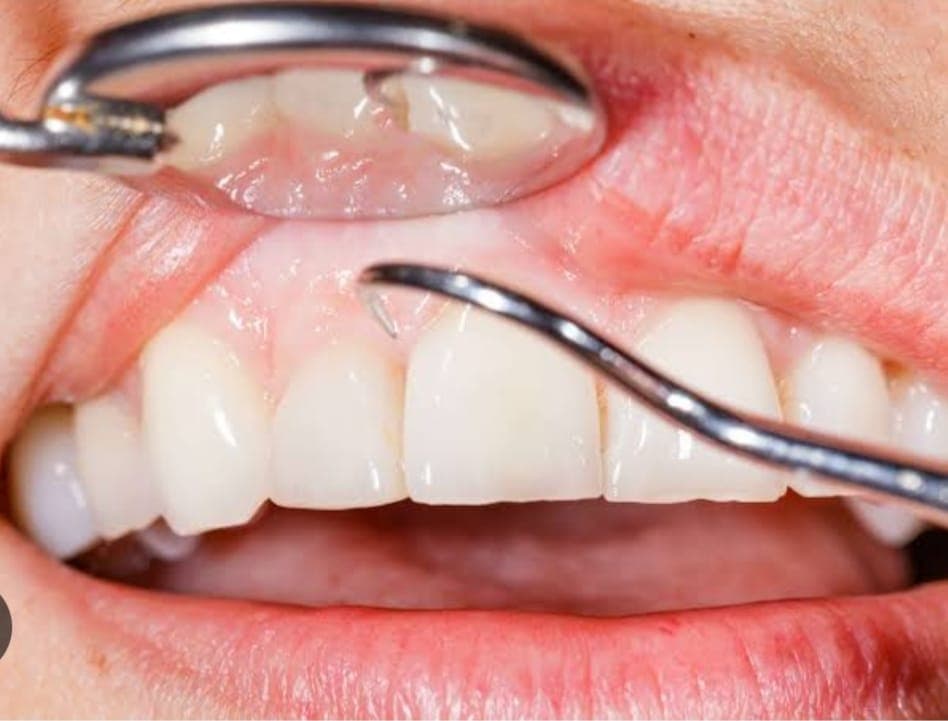 Gum Treatment